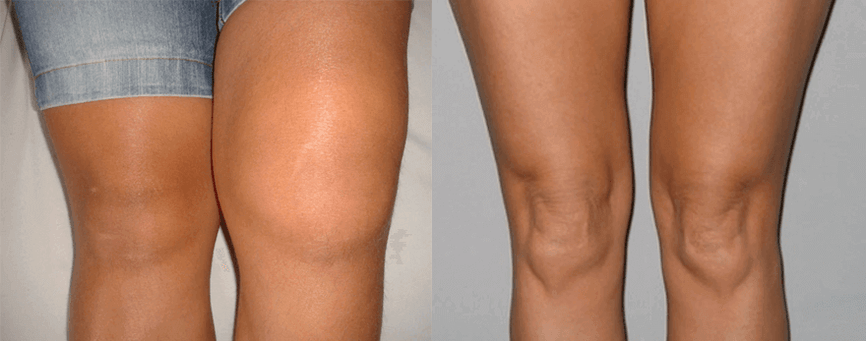 Experience using Cannabis Oil capsules before and after using Eva